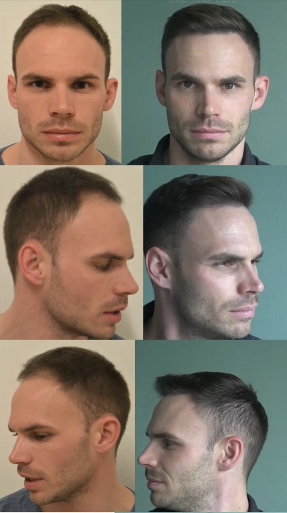 Hattingen Hair Switzerland FUE Hair Transplant.jpeg
