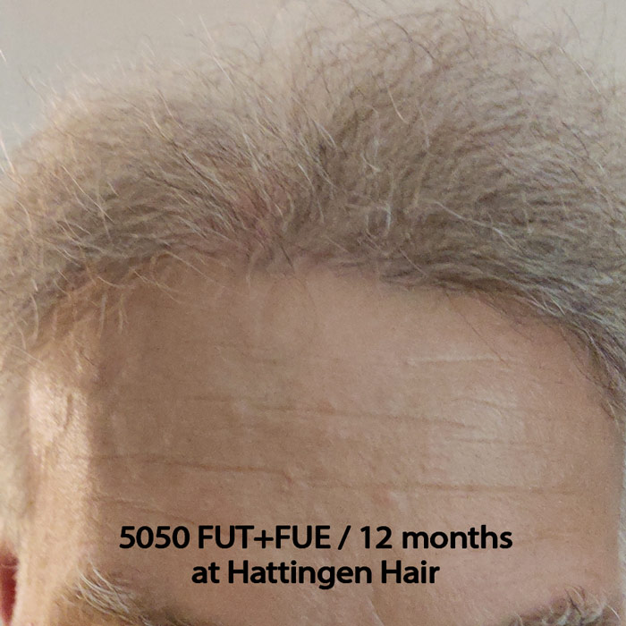 Hattingenhair-5050-fut-fue-12months-front.jpg