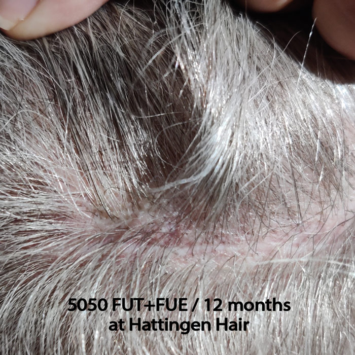 Hattingenhair-5050-fut-fue-12months-scar.jpg