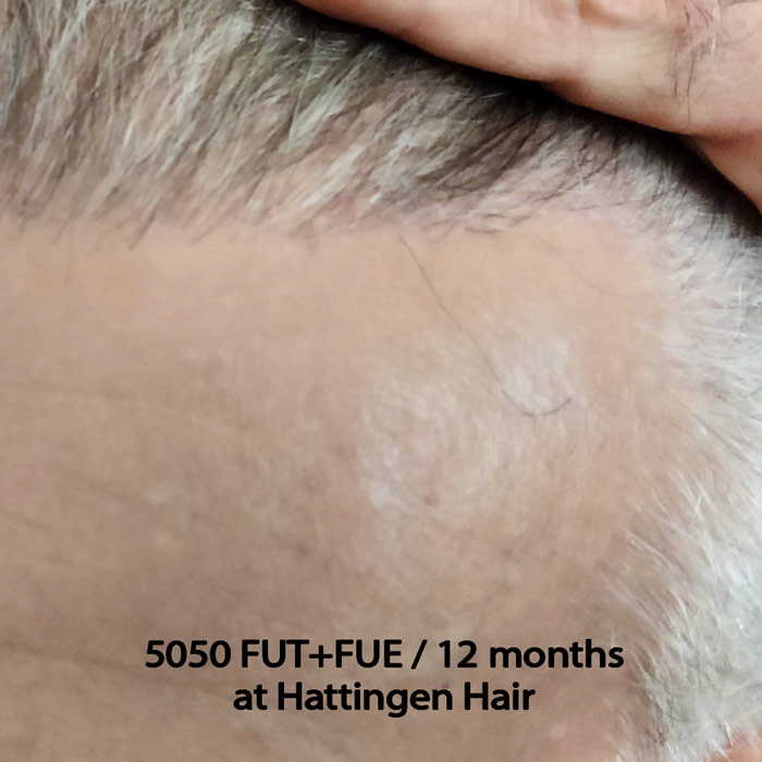 Hattingenhair-5050-fut-fue-12months-temple.jpg