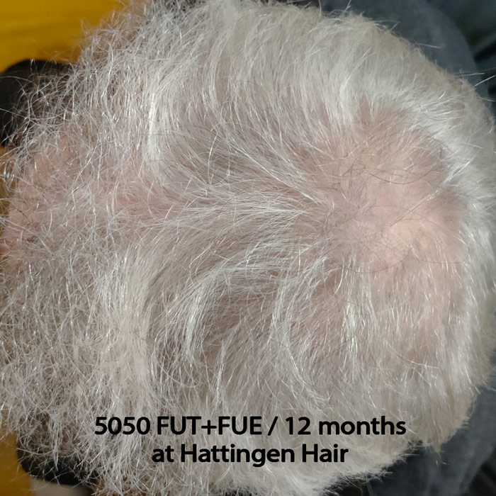 Hattingenhair-5050-fut-fue-12months-vertex.jpg