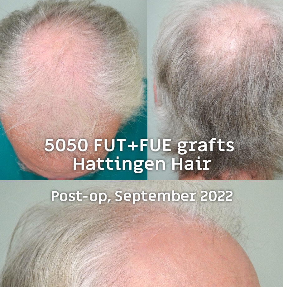 Hattingenhair-5050-FUT-FUE-combo-preop-op1-collection.jpg