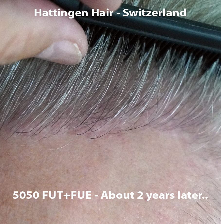 Hattingenhair-5050-FUT-FUE-combo-preop-op2-closeup.jpg