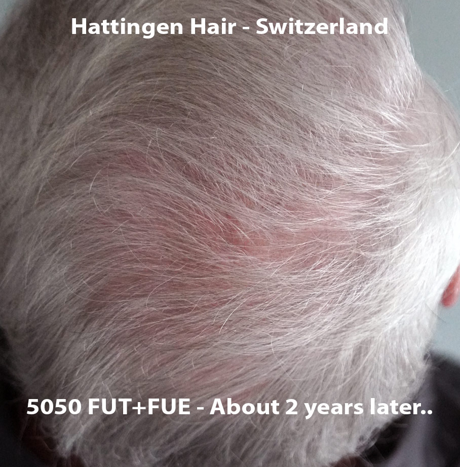 Hattingenhair-5050-FUT-FUE-combo-preop-op2-crown.jpg