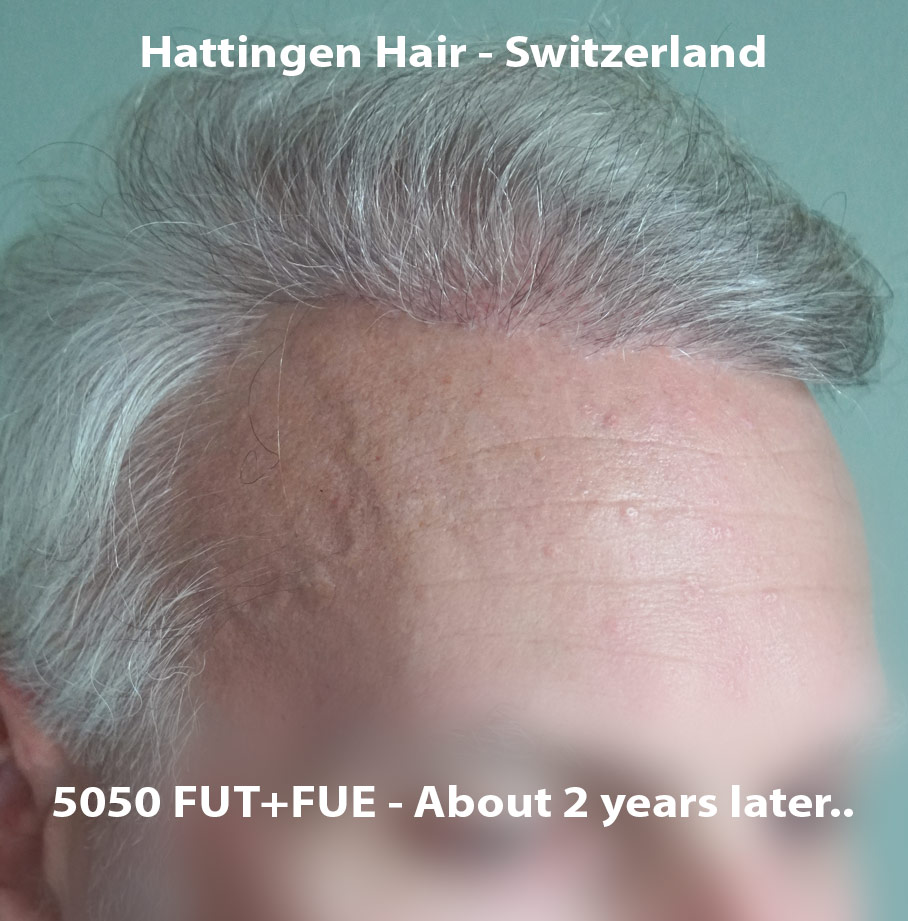 Hattingenhair-5050-FUT-FUE-combo-preop-op2-front.jpg