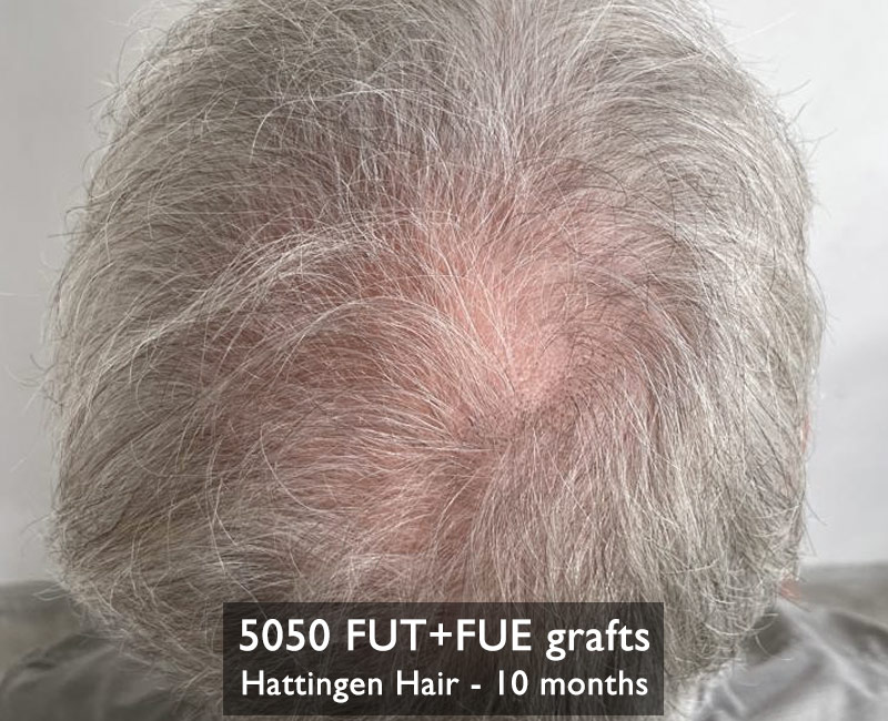 Hattingenhair-5050fut-fue-10months-crown..jpg