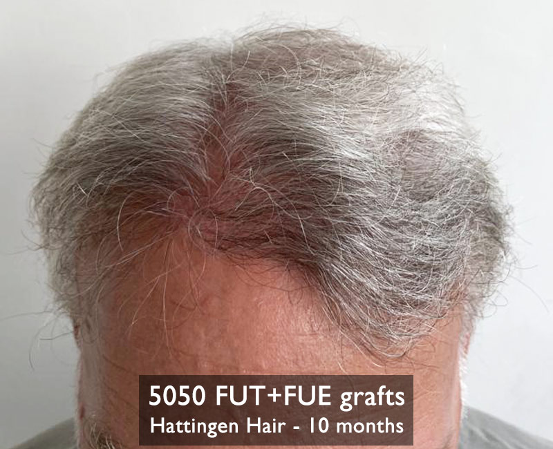 Hattingenhair-5050fut-fue-10months-front.jpg