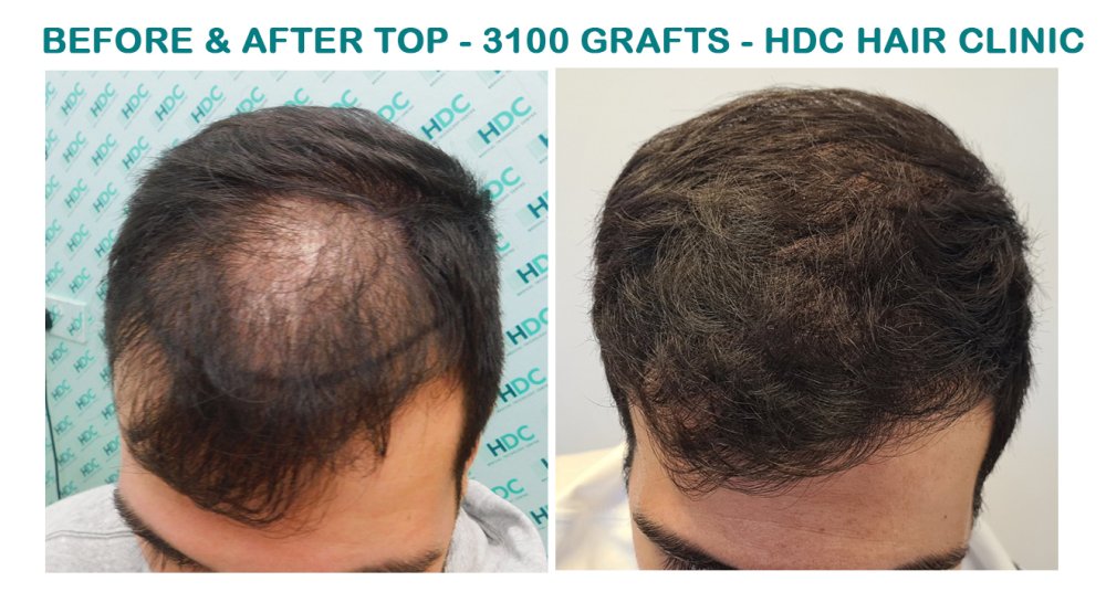 HT 20-02-24 for 3100 Grafts Set 1.jpg