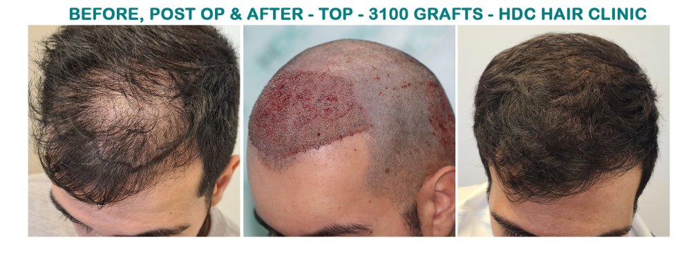 HT 20-02-24 for 3100 Grafts Set 2.jpg