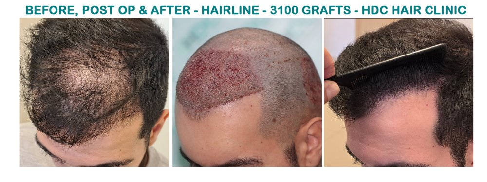 HT 20-02-24 for 3100 Grafts Set 3.jpg