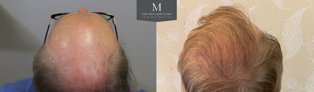 ID566_Before_After_back_above.jpg