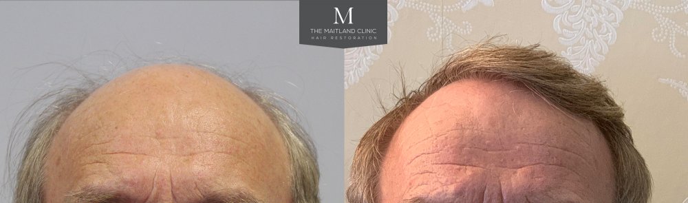 ID566_Before_After_Front.jpg