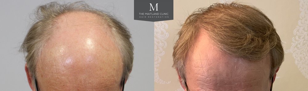 ID566_Before_After_Front_tilt.jpg