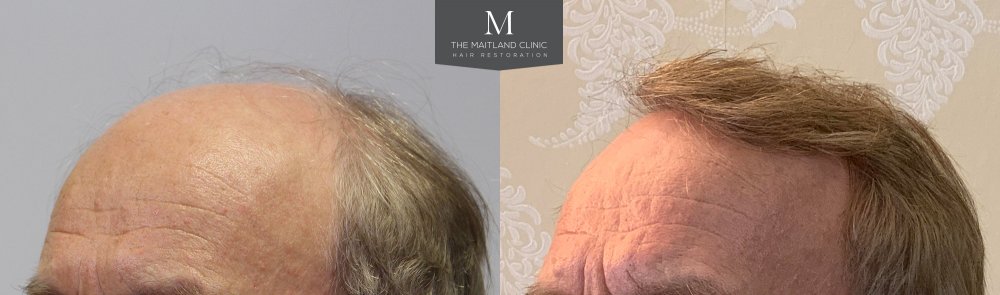 ID566_Before_After_left_45.jpg