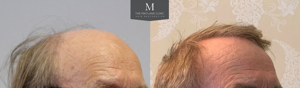 ID566_Before_After_right_45.jpg