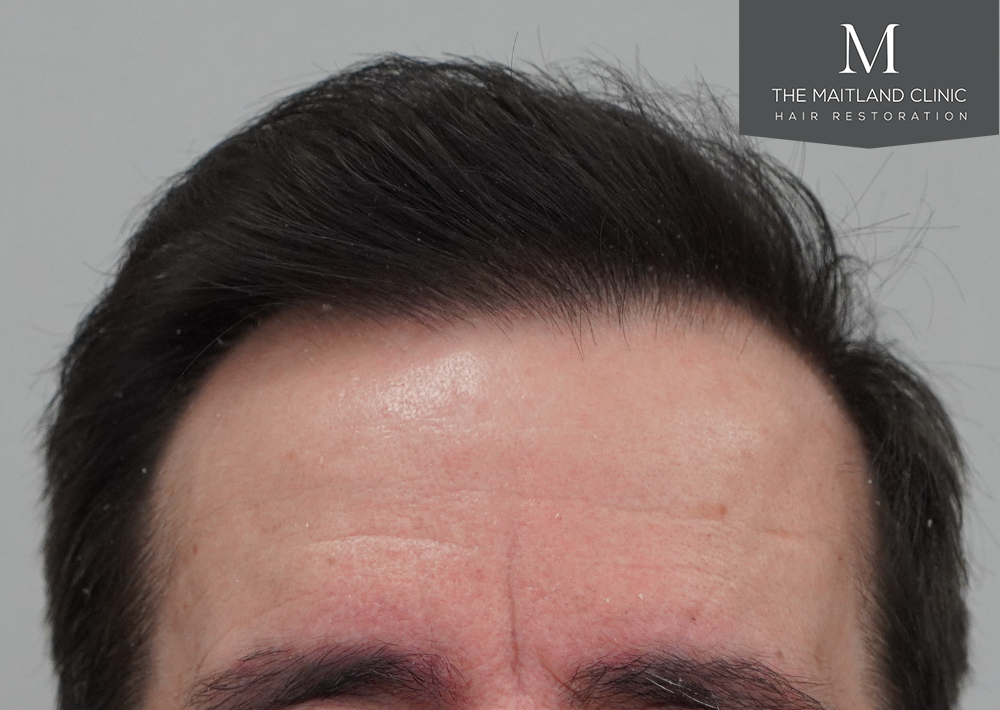 IJ_BeforeAfter-with-Blur-1.png
