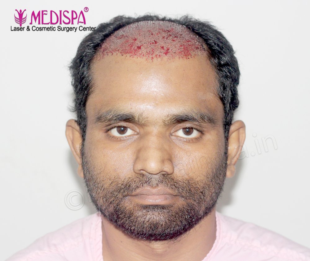 implant front.jpg