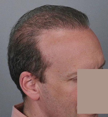 Jerry Cooley hair transplant repair Lateral Humps.jpg