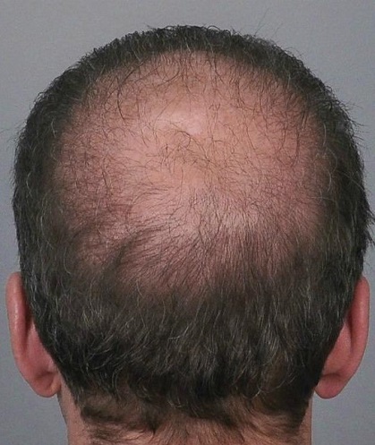 Jerry Cooley hair transplant repair1Lateral Humps.jpg