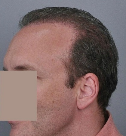 Jerry Cooley hair transplant repair2 Lateral Humps.jpg