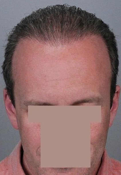 Jerry Cooley hair transplant repair3 Lateral Humps.jpg