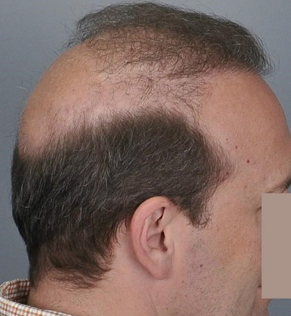 Jerry Cooley hair transplant repair5 Lateral Humps.jpg