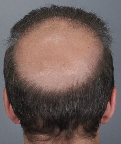 Jerry Cooley hair transplant repair6 Lateral Humps.jpg