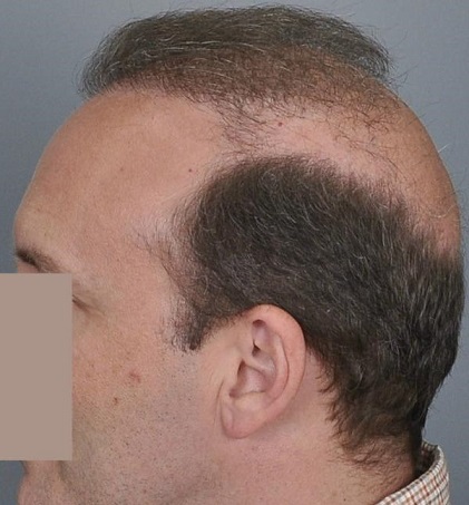 Jerry Cooley hair transplant repair7 Lateral Humps.jpg