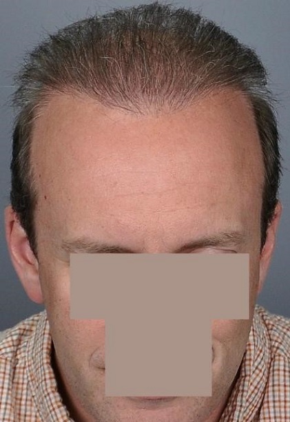Jerry Cooley hair transplant repair8 Lateral Humps.jpg
