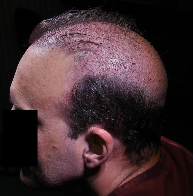 Lateral hump hair transplant..jpg