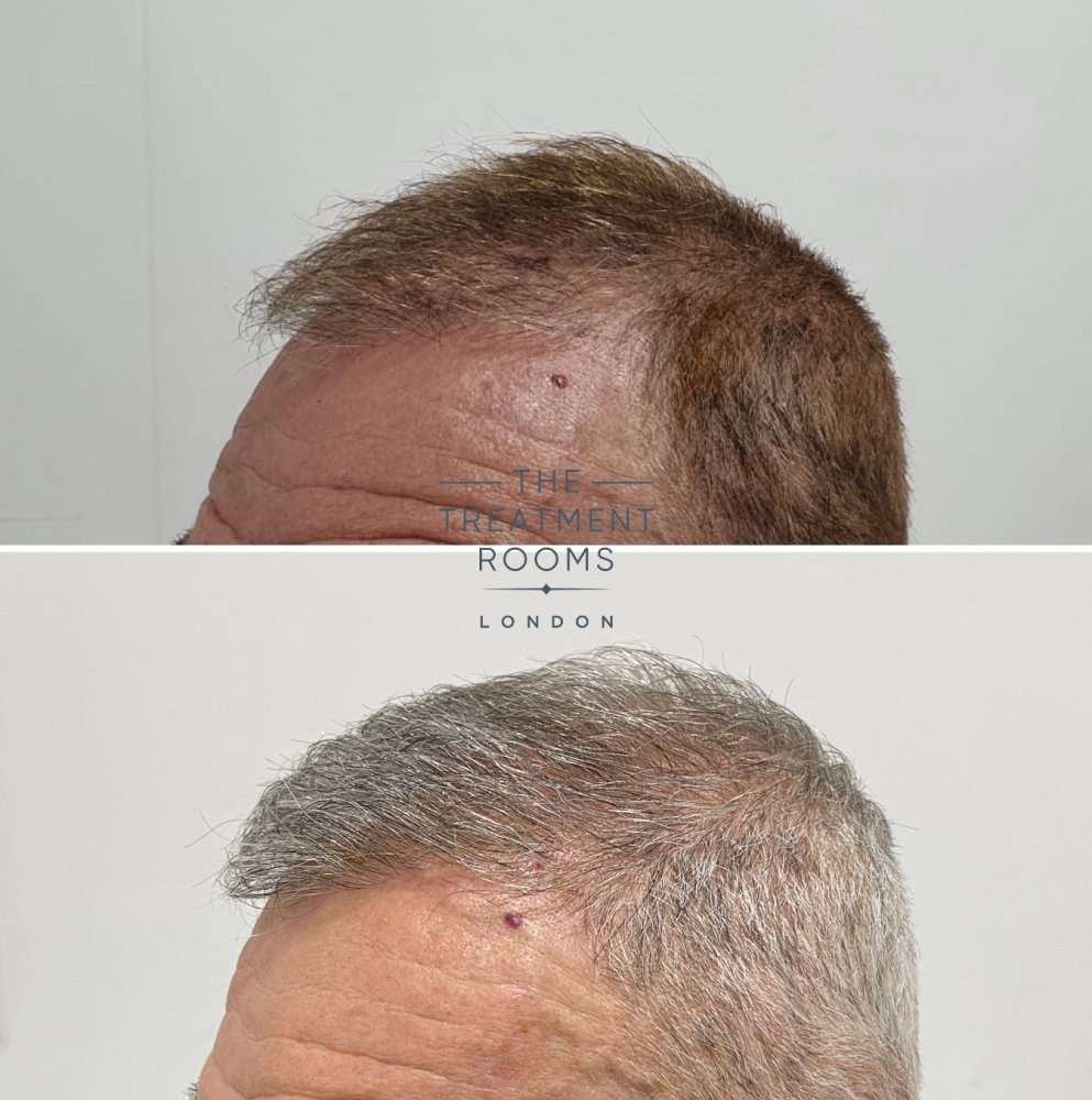 Left hair transplant repair result.jpg