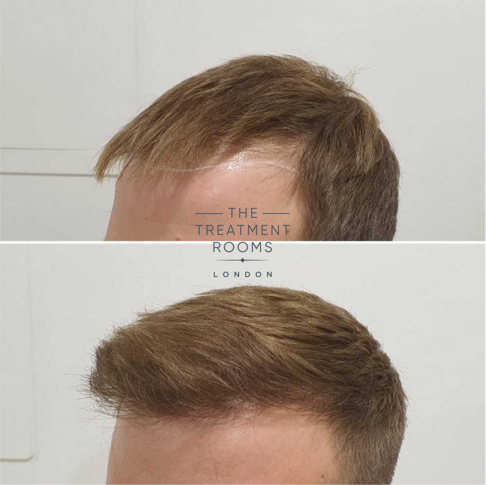 Left hairline before and after FUE hair transplant.jpg