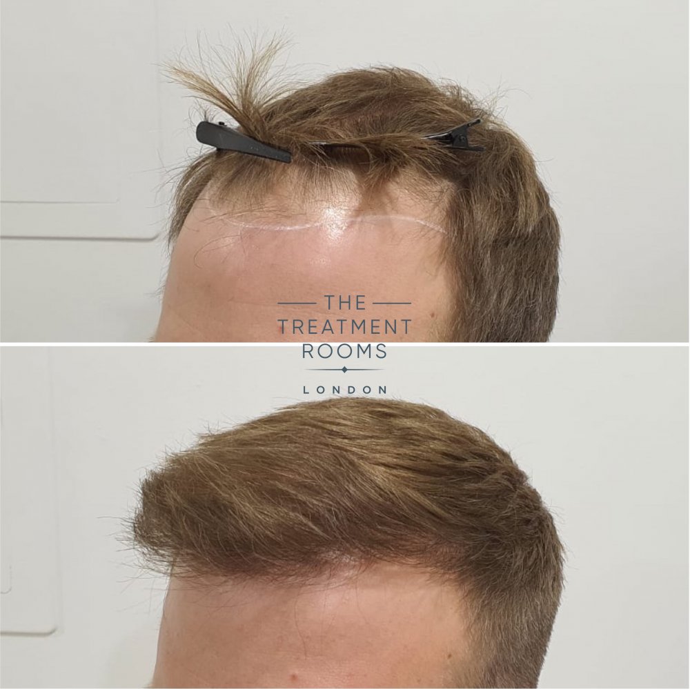 Left hairline before and after hair transplant.jpg