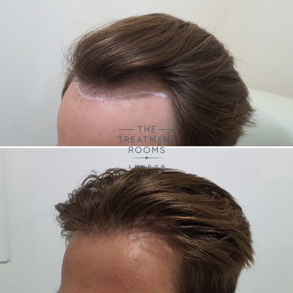 Left Hairline Before and after.jpg