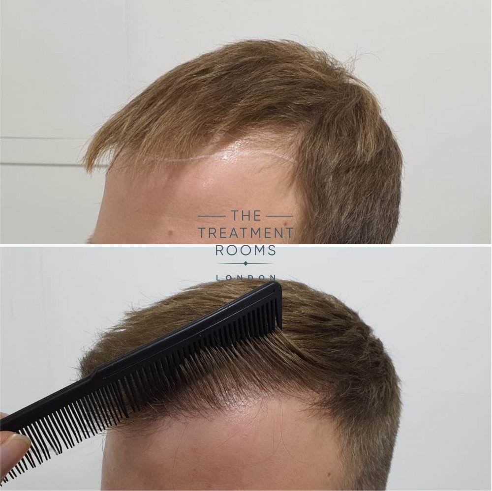Left hairline closeup before and after FUE hair transplant.jpg
