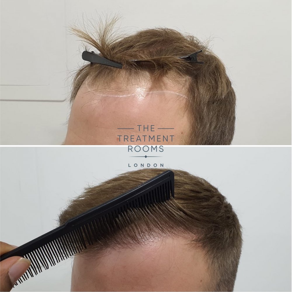 Left hairline closeup before and after hair transplant.jpg