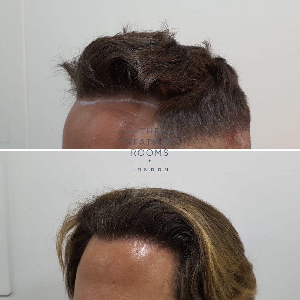 Left hairline DHI hair transplant before and after.jpg