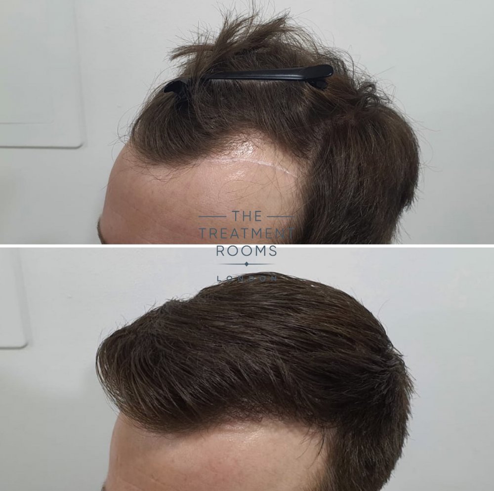 Left hairline FUE hair transplant 1100 grafts.jpg