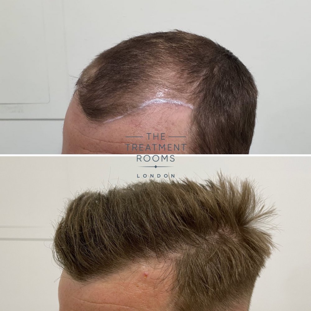 Left hairline FUE hair transplant result.jpg