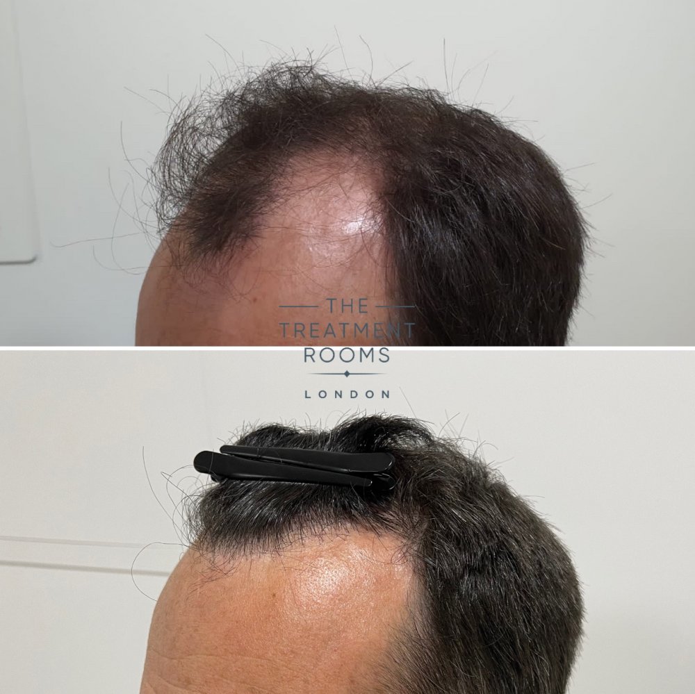 Left hairline hair transplant before and after.jpg