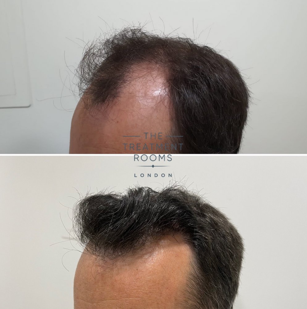 Left hairline hair transplant result.jpg