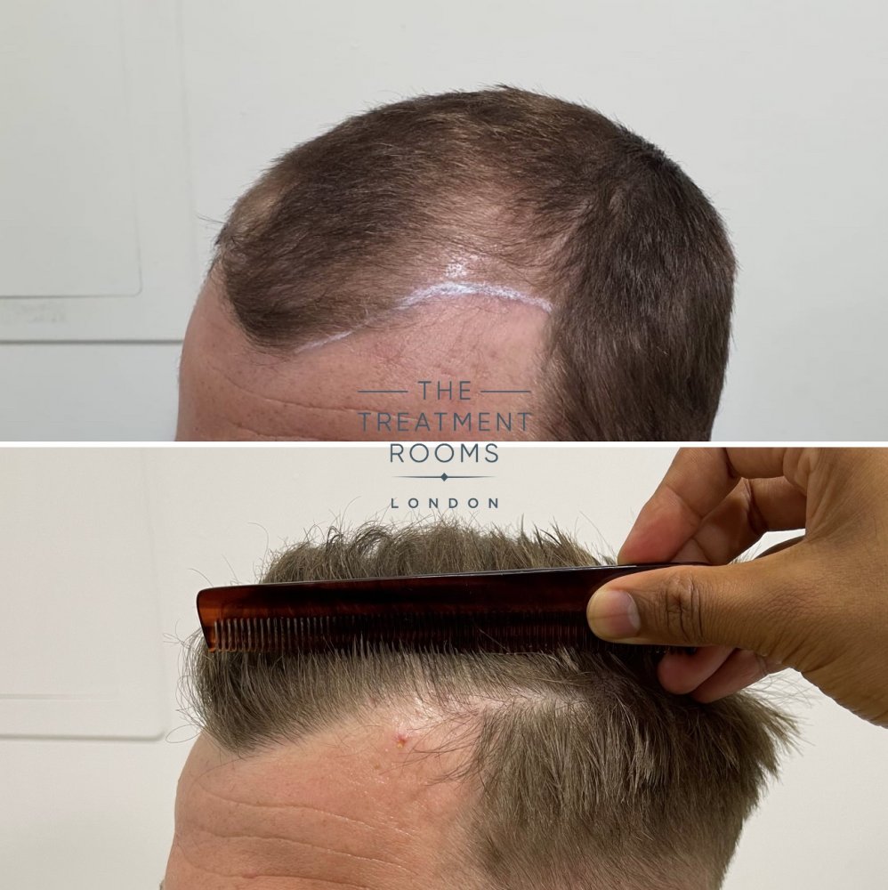 Left hairline hair transplant result with comb.jpg