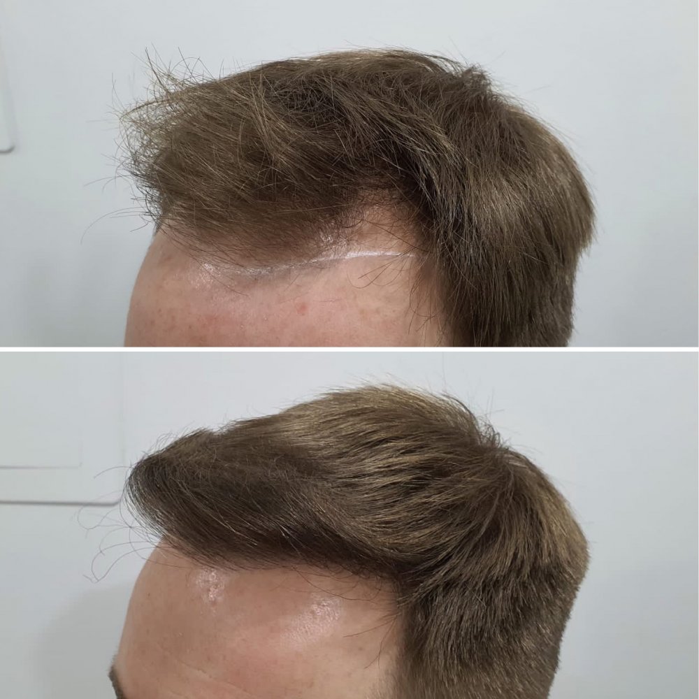 Left hairline.JPG