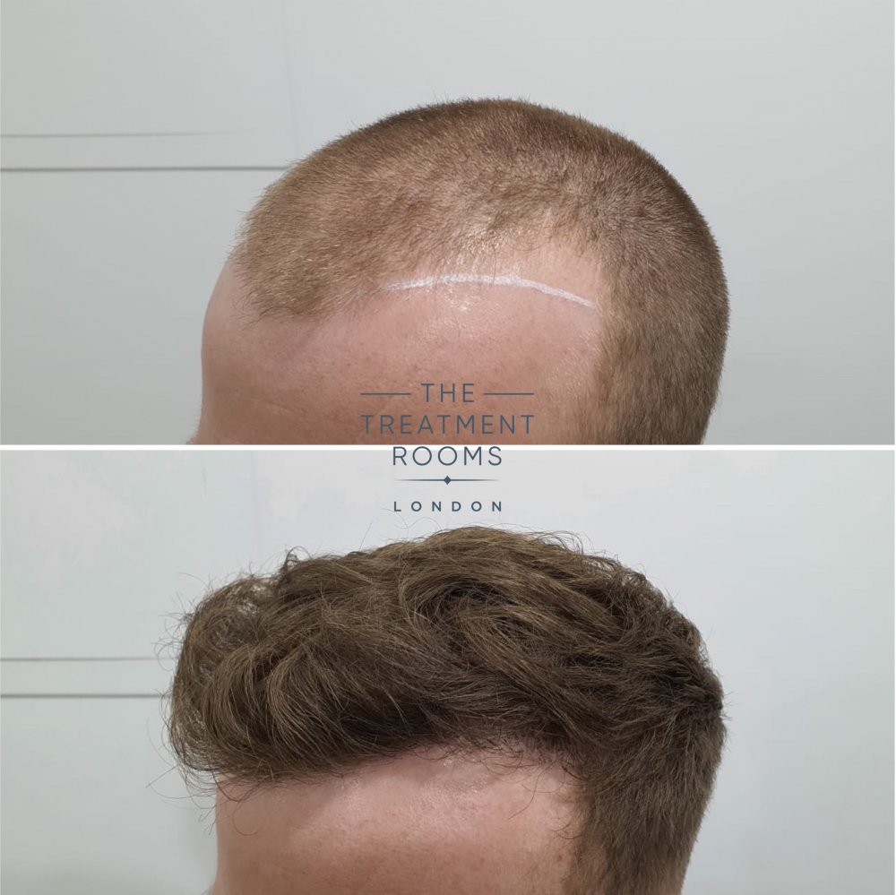 Left hairline.jpg