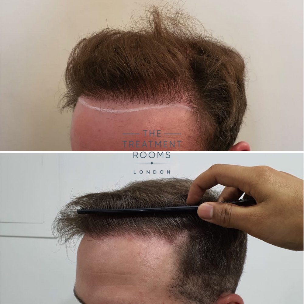 Left hairline repair hair transplant.jpg