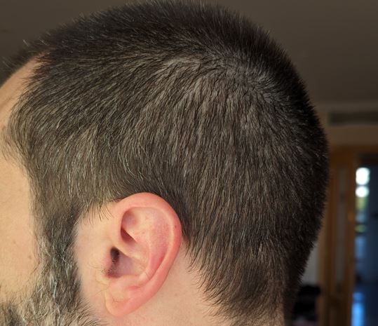 left side_4.5 mo after 2nd repair.JPG
