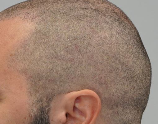 left side_4m after 1st surgery, shaved.JPG