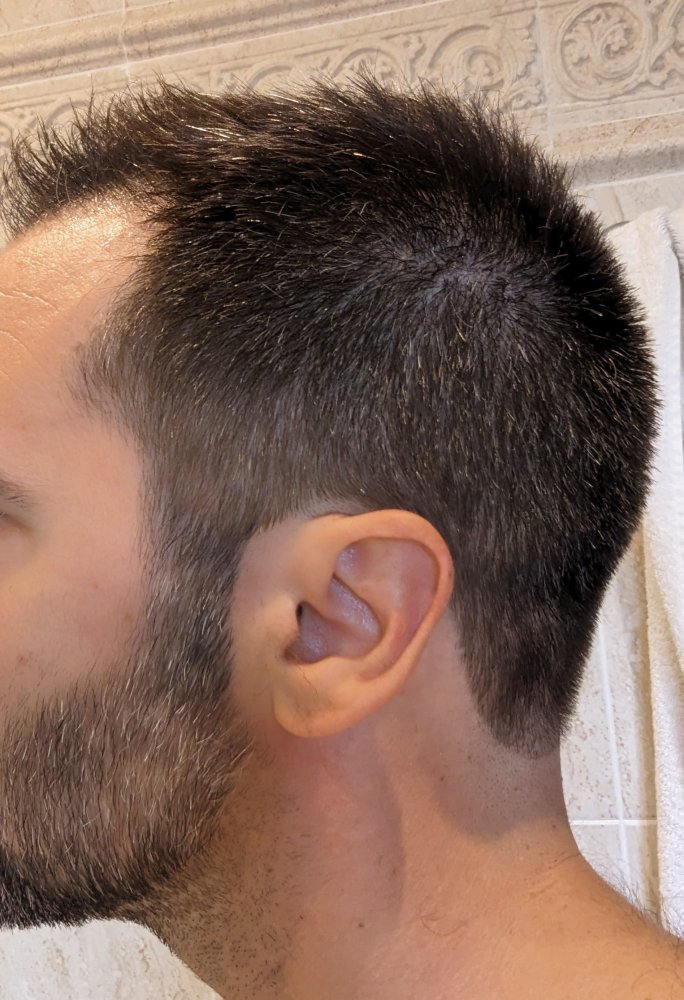 left_fixed_6 mo after.jpg