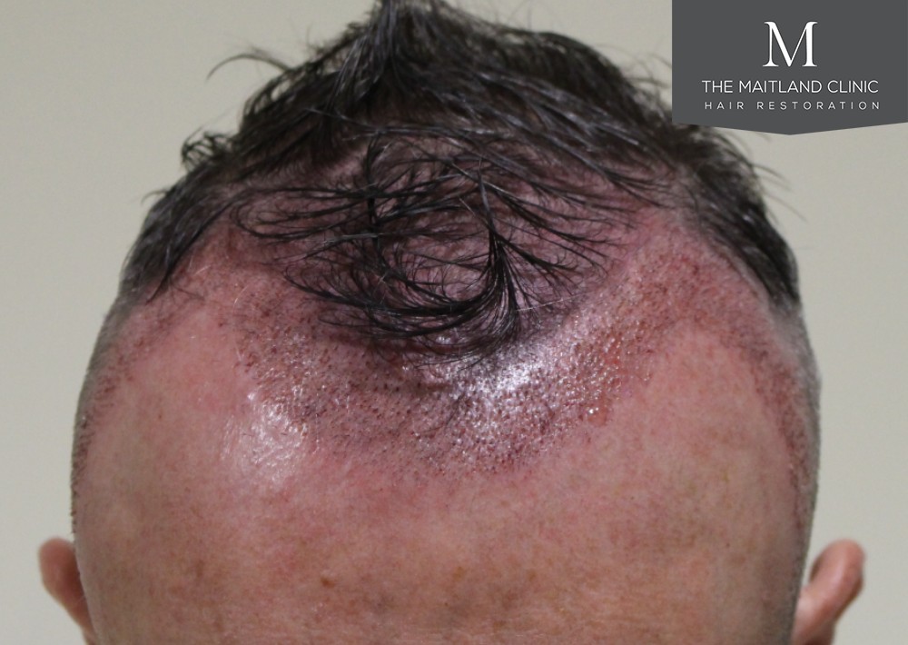 Maitland Clinic After1stFUE1.jpg