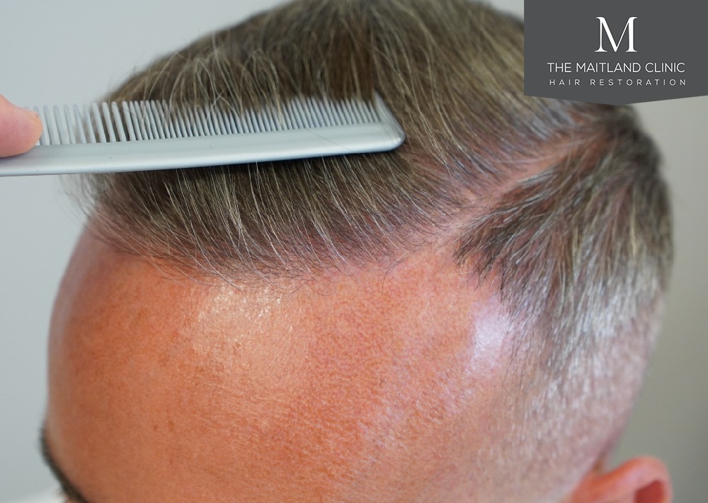 Maitland Clinic Hairline1.jpg